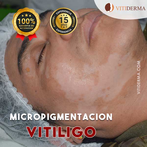 Tratamiento de Pigmentación para Vitiligo en Lima Perú
