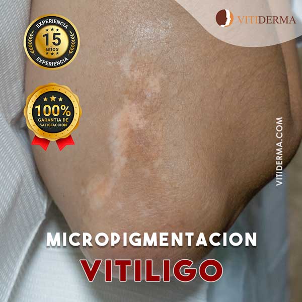 Tratamiento de Vitiligo en Lima Perú