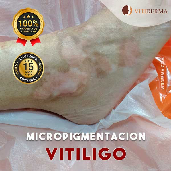 Tratamiento de Vitiligo en Lima Perú