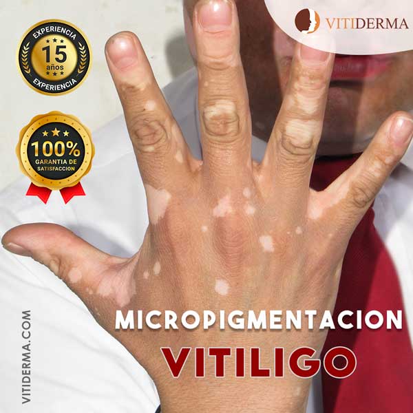 Tratamiento Micropigmentación de Vitiligo en Lima Perú